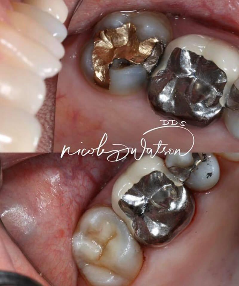 smile gallery image; before and after dental appointment