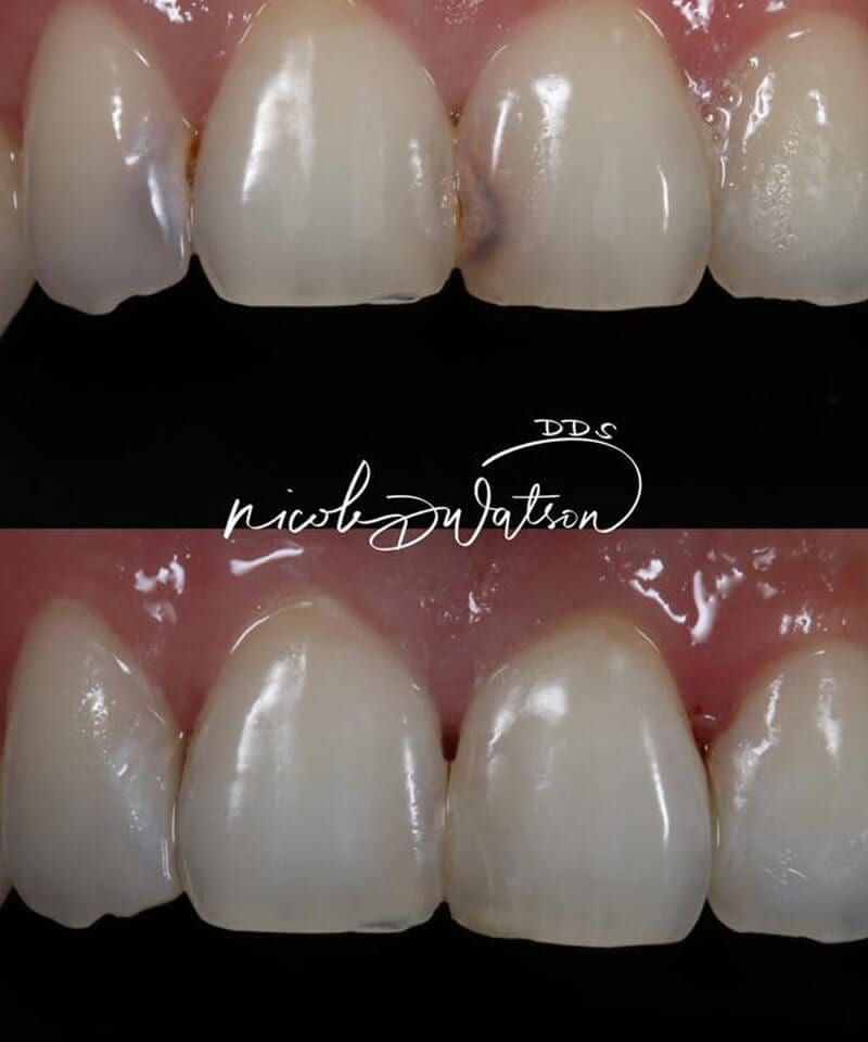 smile gallery image; before and after dental appointment